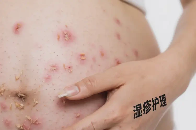 孕婦手上出現(xiàn)濕疹可不可以徹底自愈(圖4)