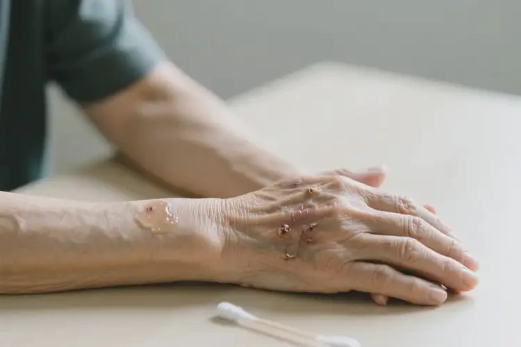 老人手臂有濕疹可不可以徹底自愈(圖2)