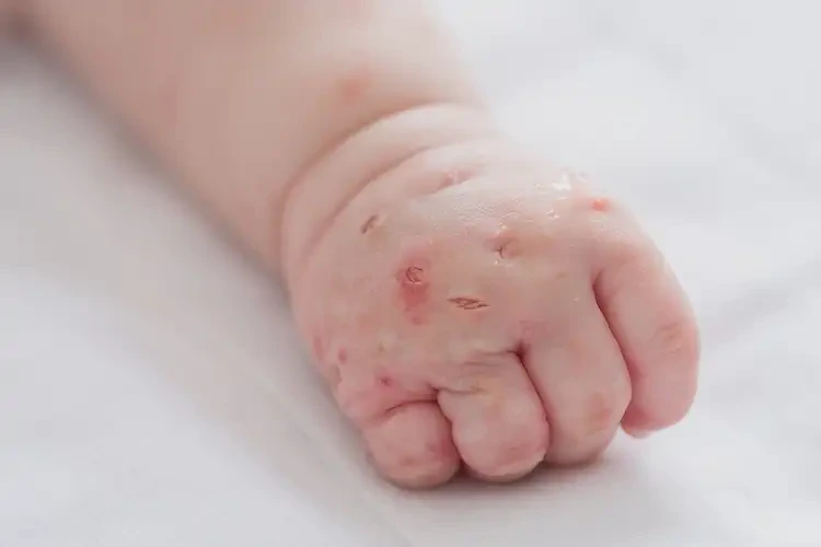 新生兒手上起濕疹不管它會(huì)自己痊愈嗎(圖1)