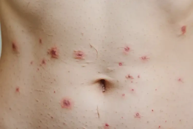 女性肚子出現(xiàn)濕疹能徹底自愈嗎(圖4)