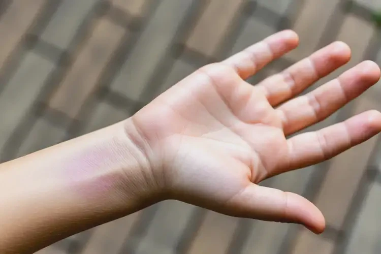 小孩手臂起湿疹能彻底自愈吗(图3)