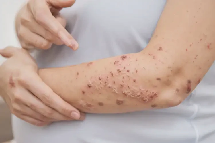 孕婦手臂上出現(xiàn)濕疹能夠徹底治愈嗎(圖4)