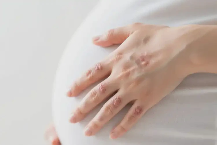 孕婦手上出濕疹能徹底自愈嗎(圖4)
