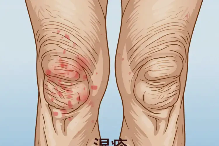 老年人大腿上容易起濕疹能徹底自愈嗎(圖2)