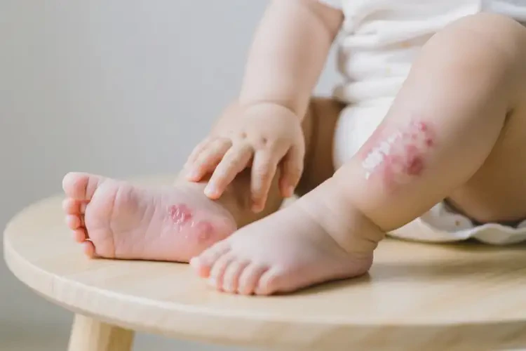 寶寶四肢偶爾起濕疹不管它會自己自愈嗎(圖1)