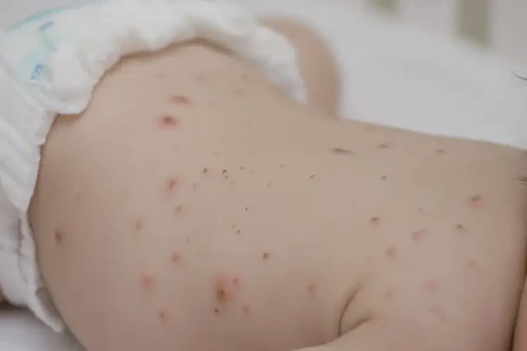 小兒屁股偶爾長濕疹能徹底自愈嗎(圖4)