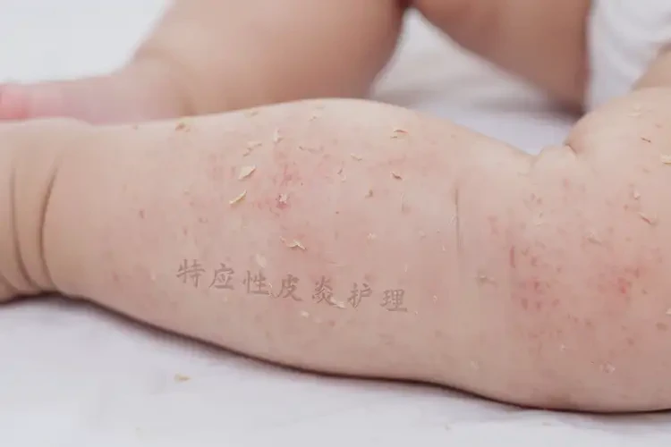 寶寶大腿出現(xiàn)濕疹不管它會自己好嗎(圖3)