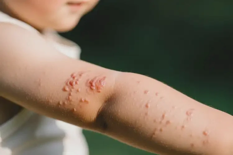 孩子四肢容易起濕疹不管它會(huì)自己自愈嗎(圖4)