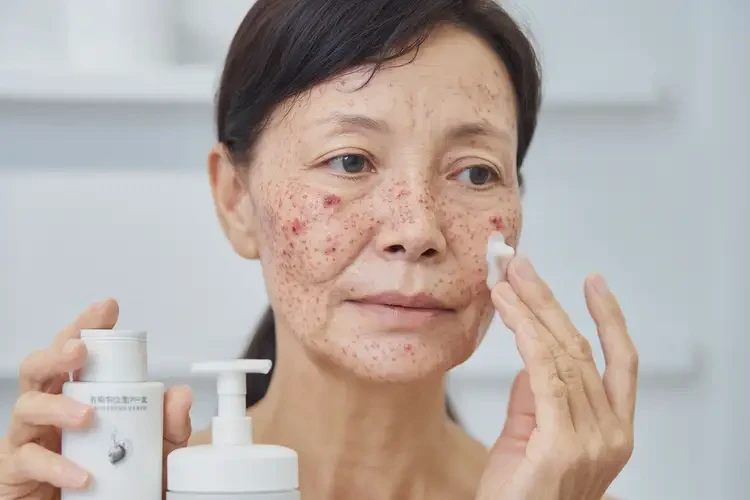 女人面部有濕疹可不可以徹底自愈(圖4)