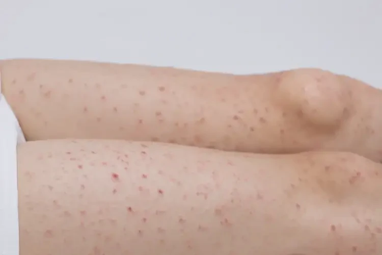 孕婦大腿上經(jīng)常長濕疹不管它會自己好嗎(圖4)