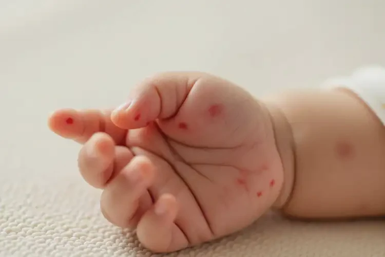 宝宝手上经常长湿疹不管它会自己好吗(图4)