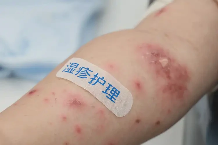 兒童屁股出濕疹不管它會自己痊愈嗎(圖4)