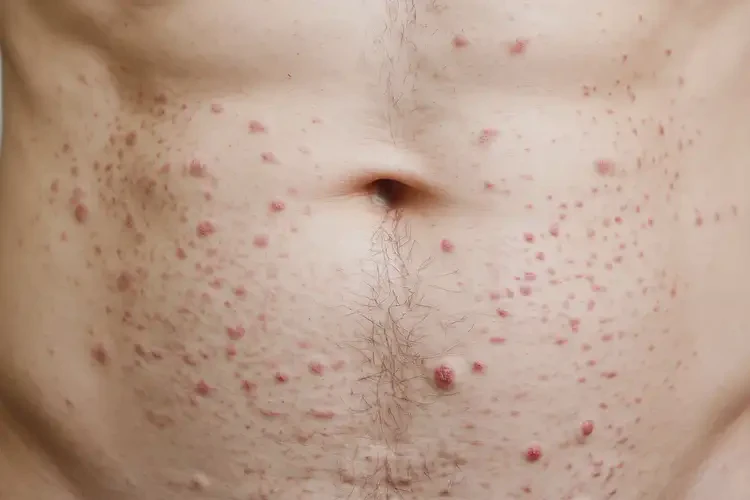 男人肚子起濕疹不管它會自己好嗎(圖4)