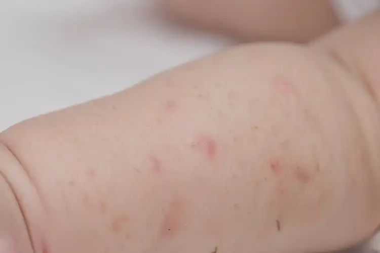 嬰兒手臂上出現(xiàn)濕疹不管它會自己好嗎(圖4)