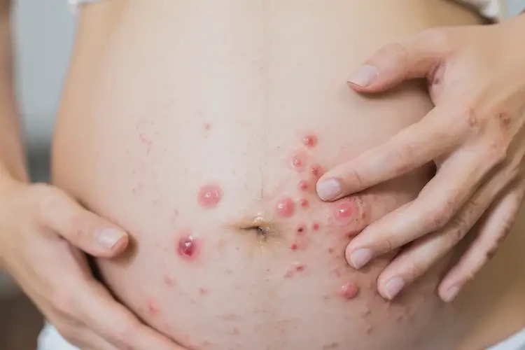 孕婦手臂經(jīng)常長(zhǎng)濕疹不管它會(huì)自己好嗎(圖4)