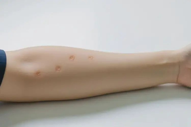 大學(xué)生手臂偶爾起濕疹不管它會(huì)自己好嗎(圖4)