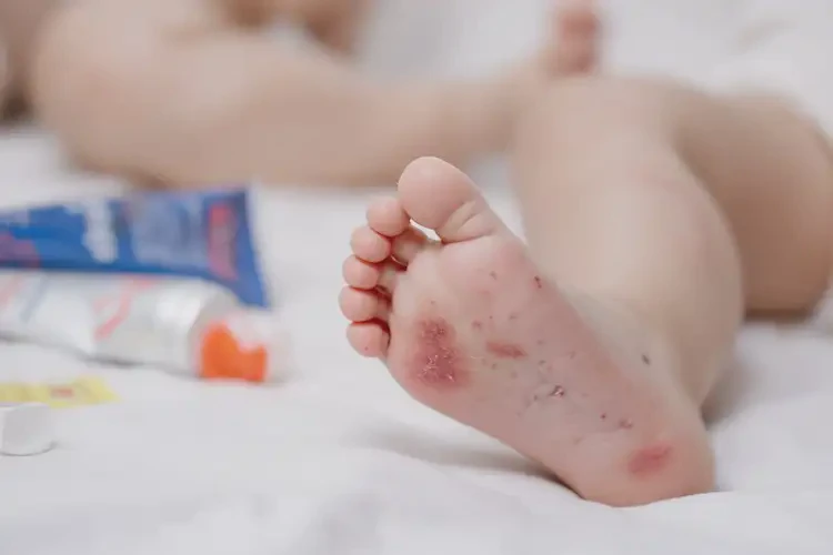 寶寶腳上容易起濕疹能夠徹底治愈嗎(圖4)