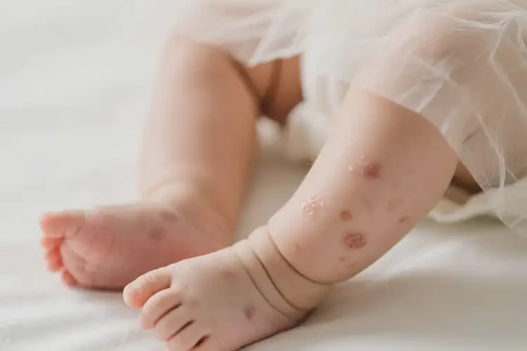 嬰兒小腿偶爾起濕疹能夠徹底治愈嗎(圖2)