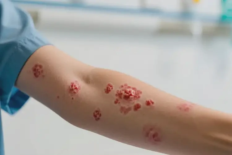 青少年手臂出濕疹不管它會(huì)自己好嗎(圖4)