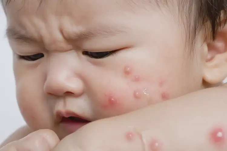 寶寶屁股上經(jīng)常長(zhǎng)濕疹不管它會(huì)自己好嗎(圖4)