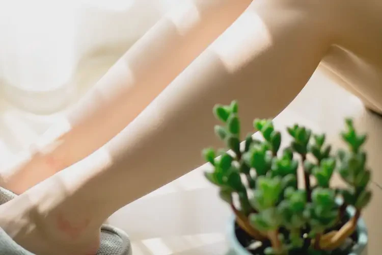 孕婦四肢偶爾起濕疹能靠自己自愈嗎(圖1)