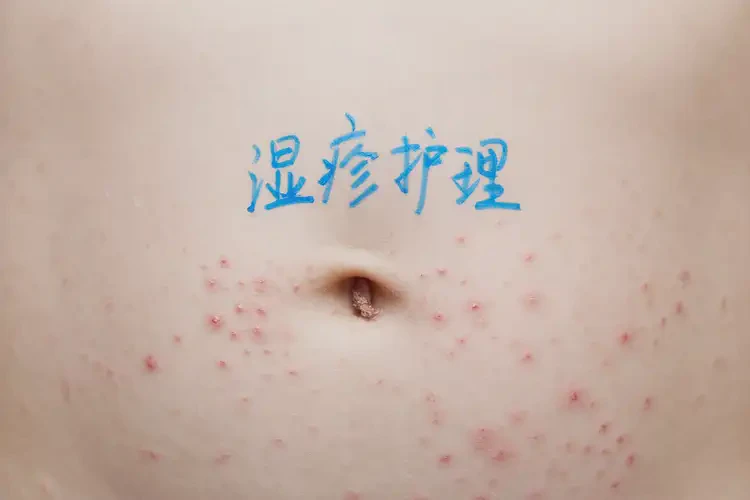 少兒肚子上有濕疹可以徹底自愈嗎(圖3)