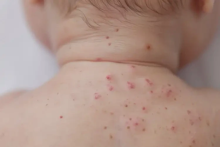 新生兒脖子上偶爾起濕疹能徹底自愈嗎(圖4)