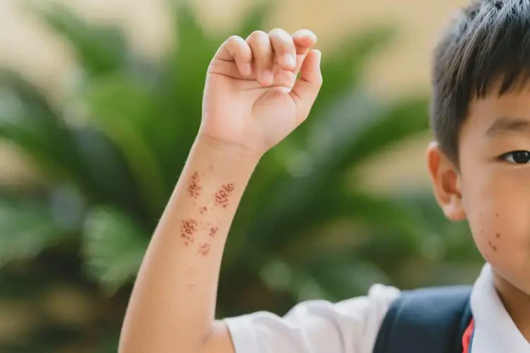 小學生手臂偶爾長濕疹能靠自己自愈嗎(圖3)