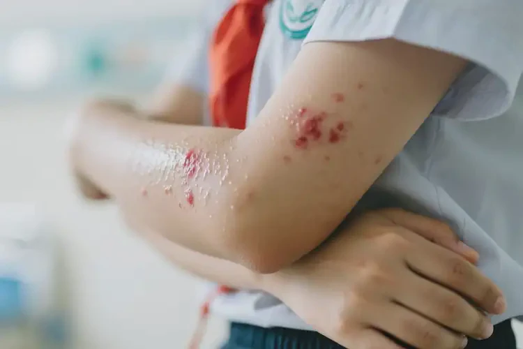 中學(xué)生手臂上出濕疹不管它會自己痊愈嗎(圖4)