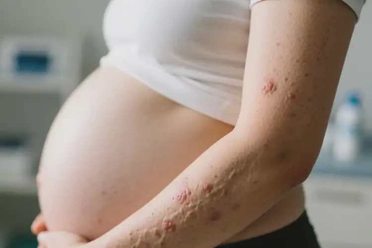 產(chǎn)婦手臂偶爾起濕疹不管它會自己痊愈嗎(圖4)