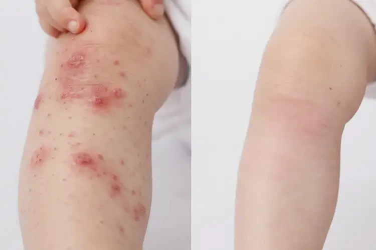 兒童四肢容易起濕疹可不可以徹底自愈(圖1)