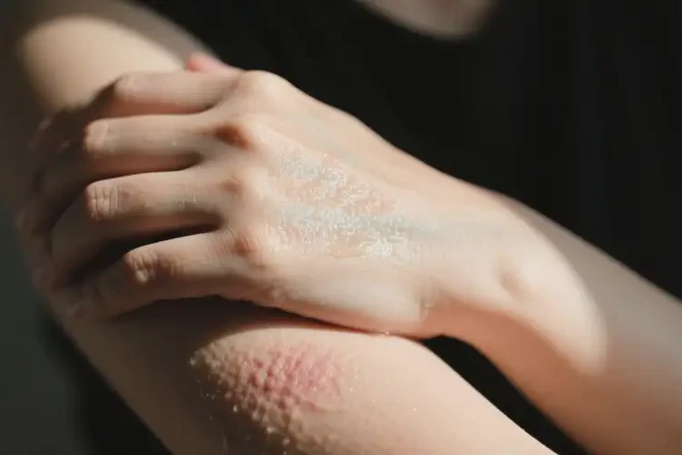 女人手臂出濕疹可以徹底自愈嗎(圖2)