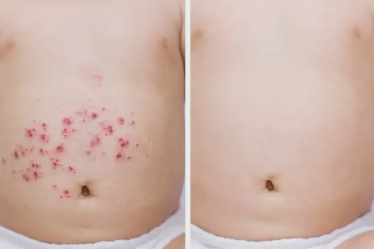 小兒肚子容易起濕疹不管它會(huì)自己痊愈嗎(圖2)