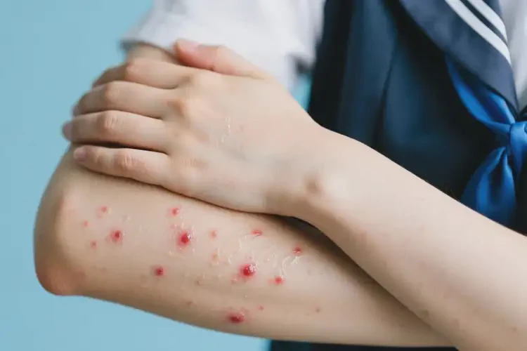 大學(xué)生手臂上經(jīng)常長(zhǎng)濕疹能徹底自愈嗎(圖2)