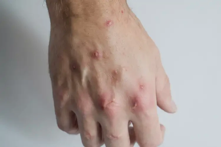 男生手上有濕疹不管它會(huì)自己痊愈嗎(圖4)