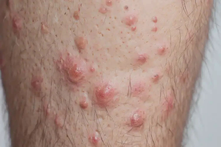 男性小腿經(jīng)常長(zhǎng)濕疹不管它會(huì)自己痊愈嗎(圖4)