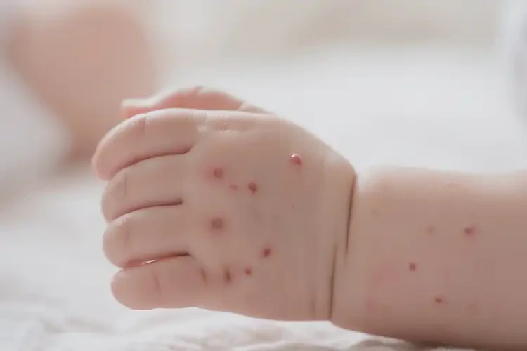 寶寶手上起濕疹不管它會自己好嗎