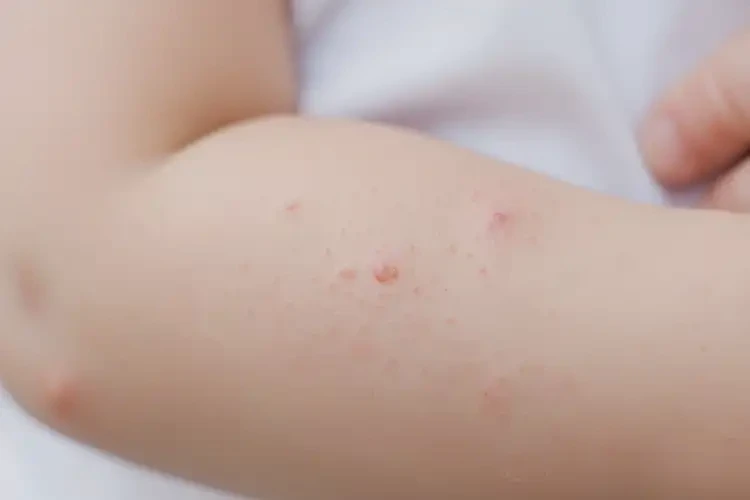 小孩手臂偶爾起濕疹可不可以徹底自愈(圖4)