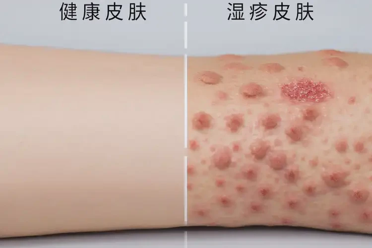 男生屁股上容易起濕疹能靠自己自愈嗎(圖3)