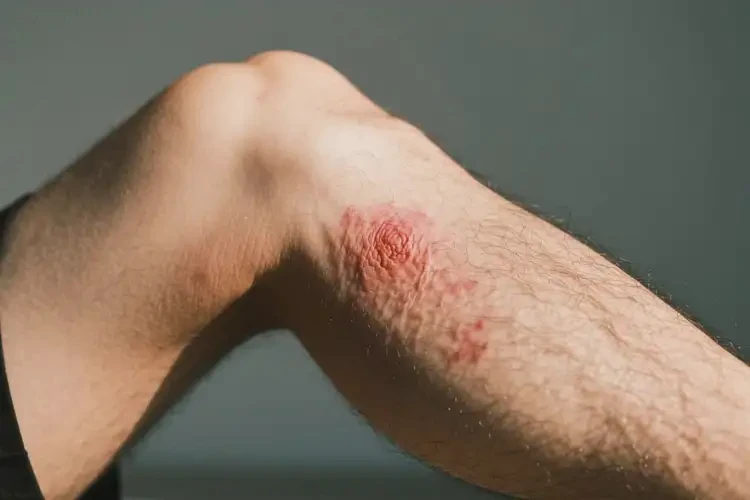 男生大腿出現(xiàn)濕疹能靠自己自愈嗎(圖2)