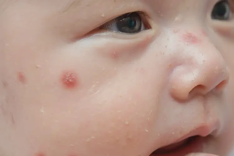 新生兒全身經(jīng)常長濕疹不管它會(huì)自己痊愈嗎(圖4)
