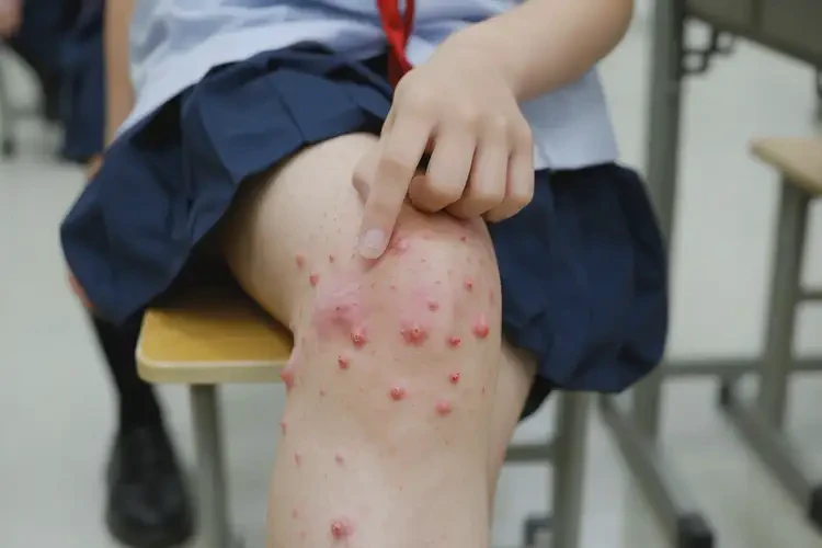 中學(xué)生大腿經(jīng)常長(zhǎng)濕疹能不能徹底自愈(圖4)