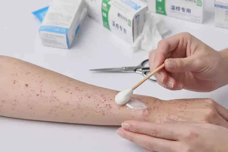 中学生屁股上容易起湿疹能不能彻底自愈(图2)