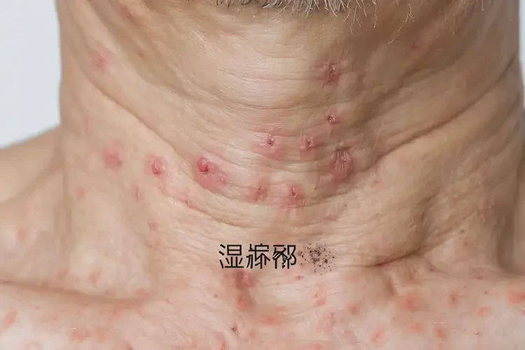 男人脖子出現(xiàn)濕疹可不可以徹底自愈(圖4)