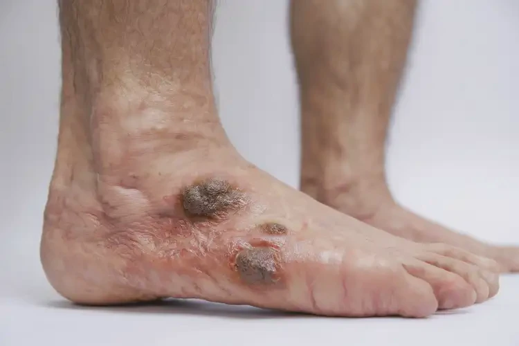 男性腳上出現(xiàn)濕疹不管它會自己好嗎(圖3)