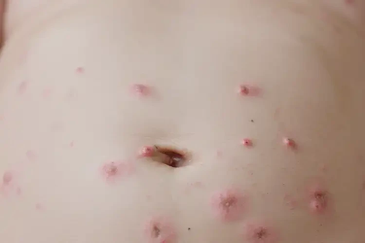 嬰幼兒肚子上有濕疹不管它會(huì)自己痊愈嗎(圖4)