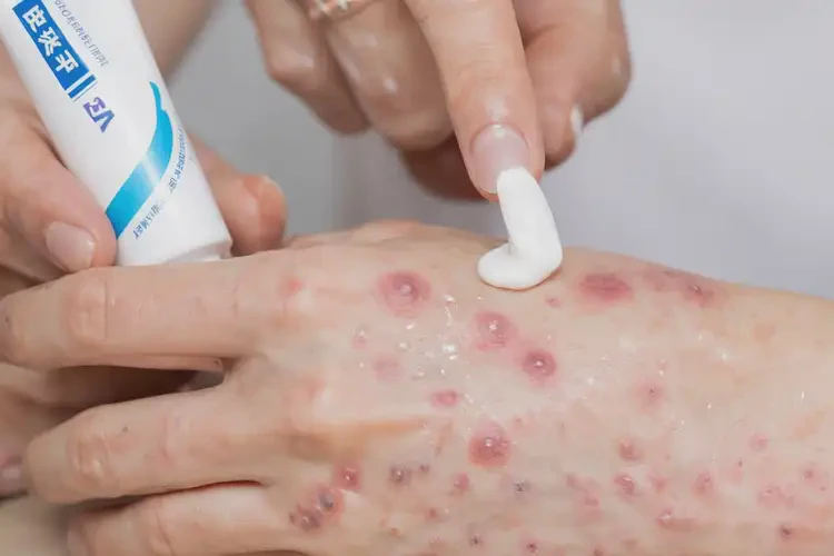 女人手上起濕疹不管它會(huì)自己痊愈嗎(圖3)