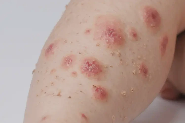 少兒小腿經常長濕疹能徹底自愈嗎(圖4)