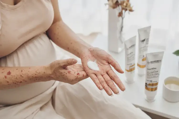 孕婦手上出現(xiàn)濕疹可不可以徹底自愈(圖3)