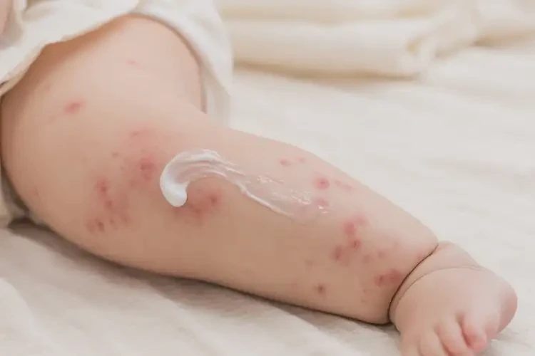 嬰兒大腿經(jīng)常長(zhǎng)濕疹可以徹底自愈嗎(圖2)